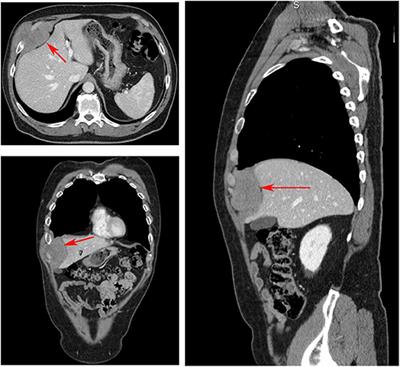 3D Reconstruction Model of an Extra-Abdominal Desmoid Tumor: A Case Study